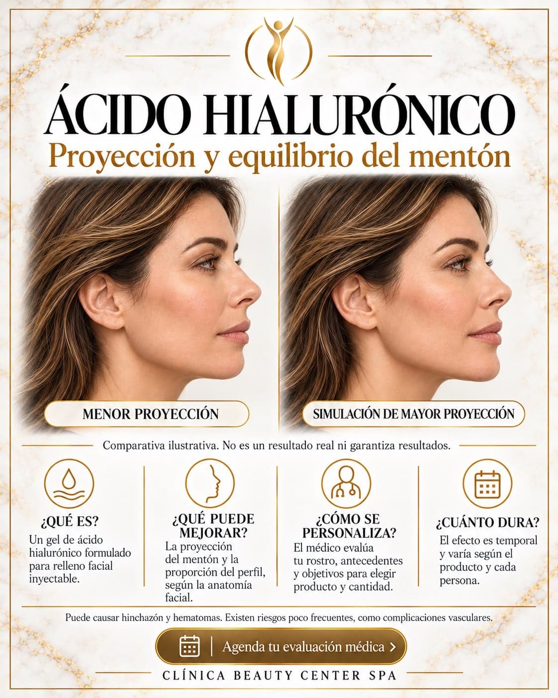 Infografía Ácido hialurónico: proyección y equilibrio del mentón, comparativa ilustrativa