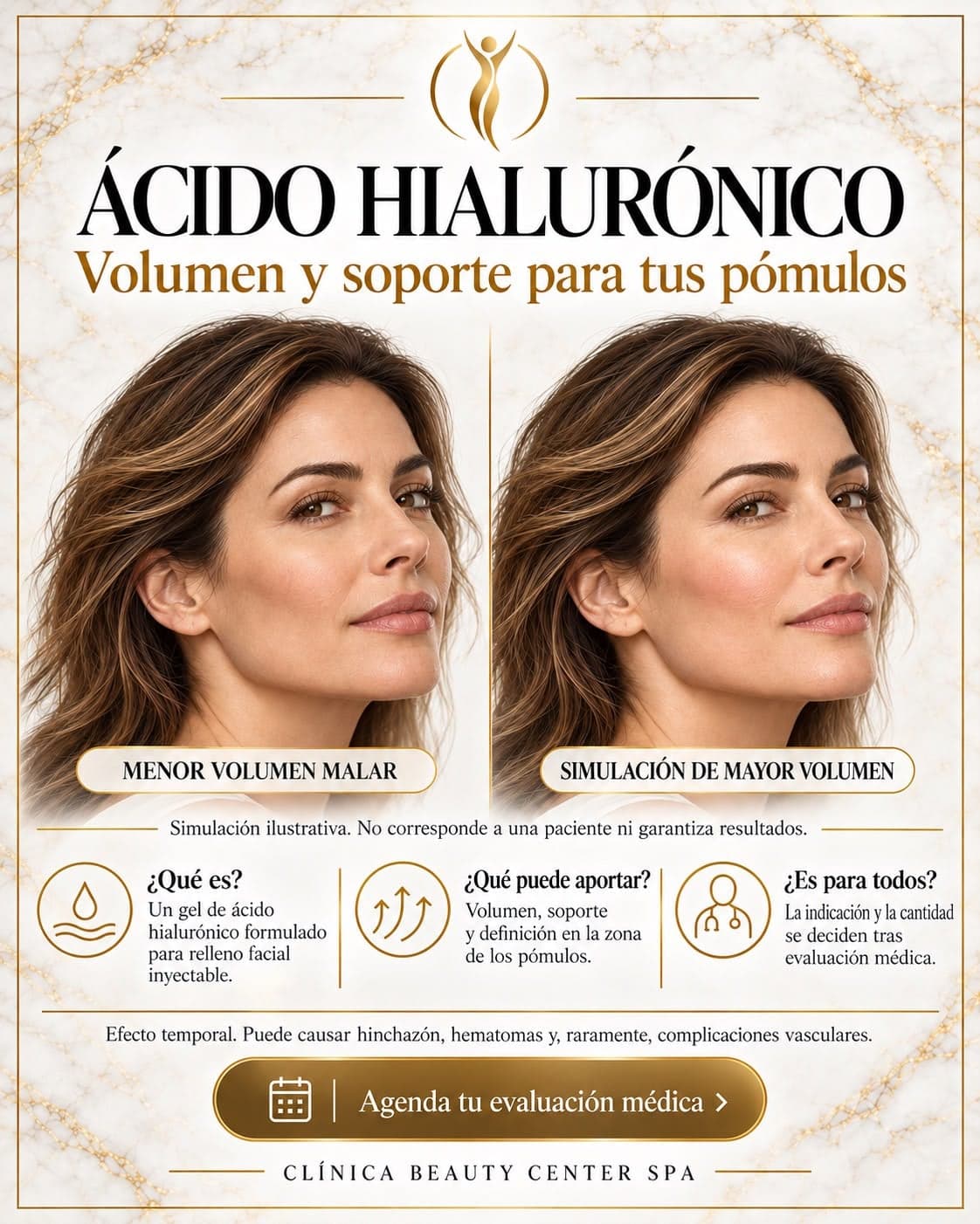 Infografía Ácido hialurónico: volumen y soporte para tus pómulos, simulación ilustrativa