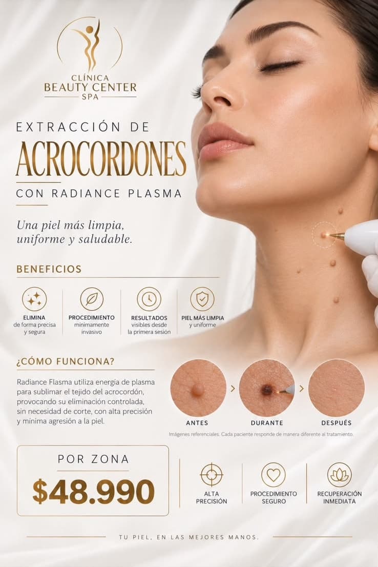 Infografía extracción de acrocordones con Radiance Plasma: beneficios y antes, durante y después