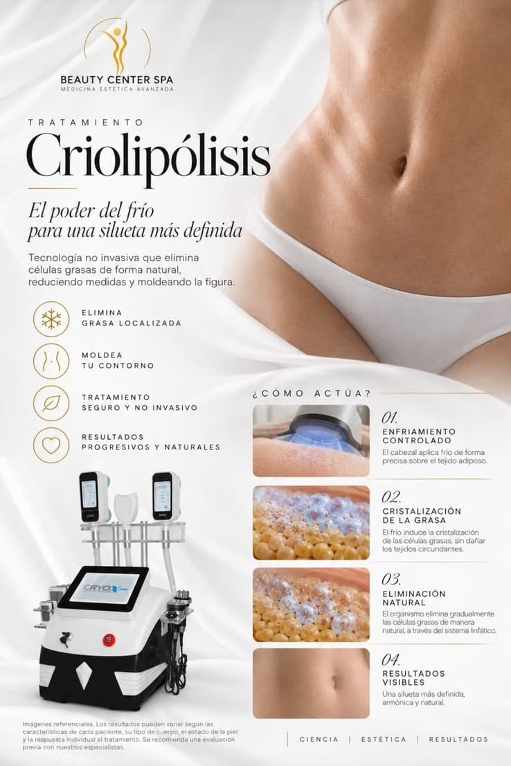 Infografía tratamiento Criolipólisis: beneficios y cómo actúa en cuatro pasos