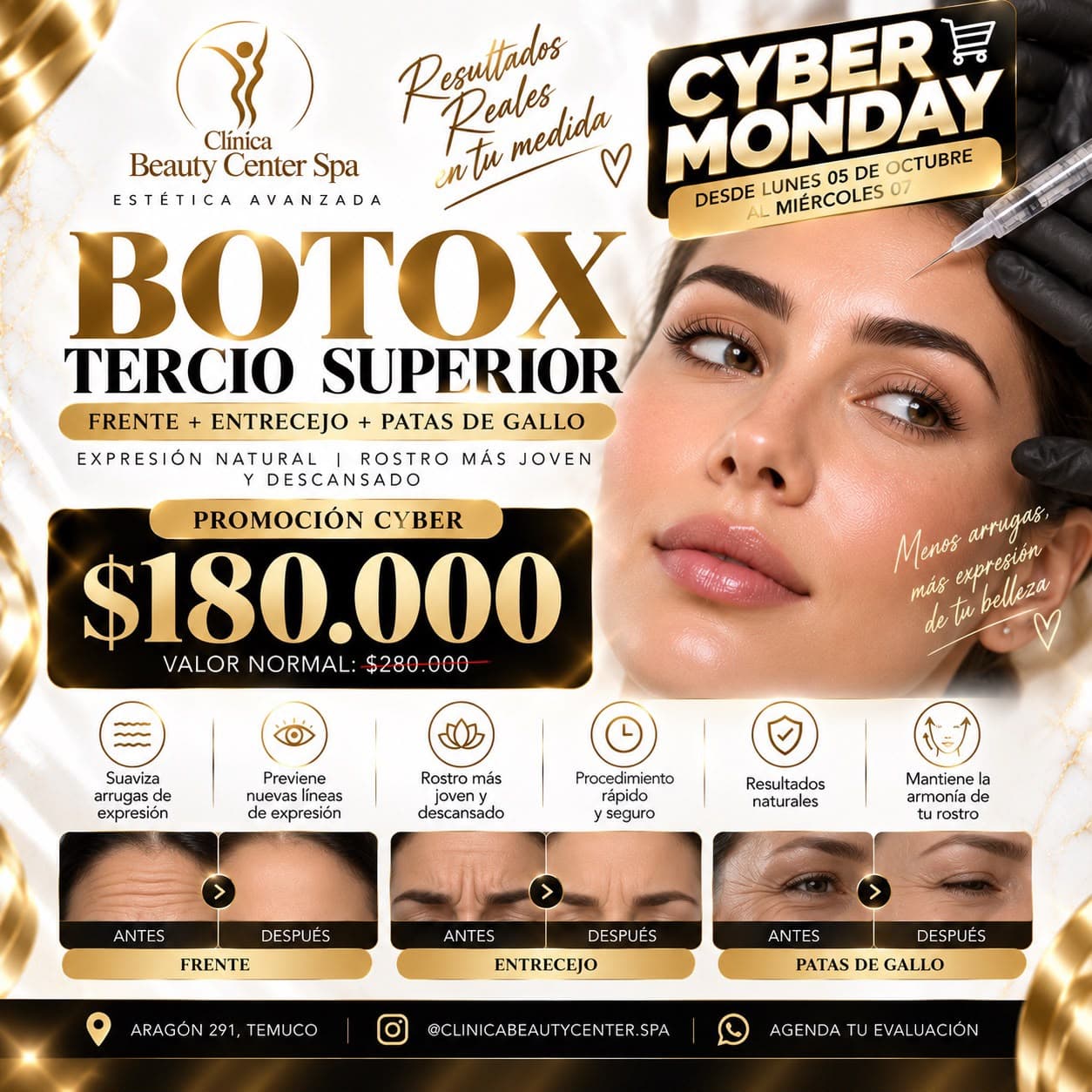Promoción Cyber botox tercio superior: frente, entrecejo y patas de gallo a $180.000