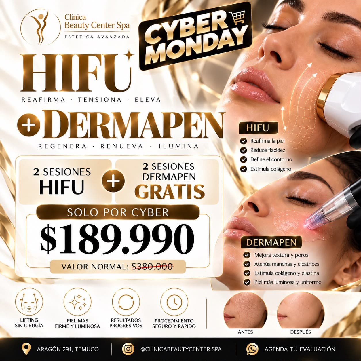 Promoción Cyber 2 sesiones de HIFU más 2 sesiones de Dermapen gratis a $189.990