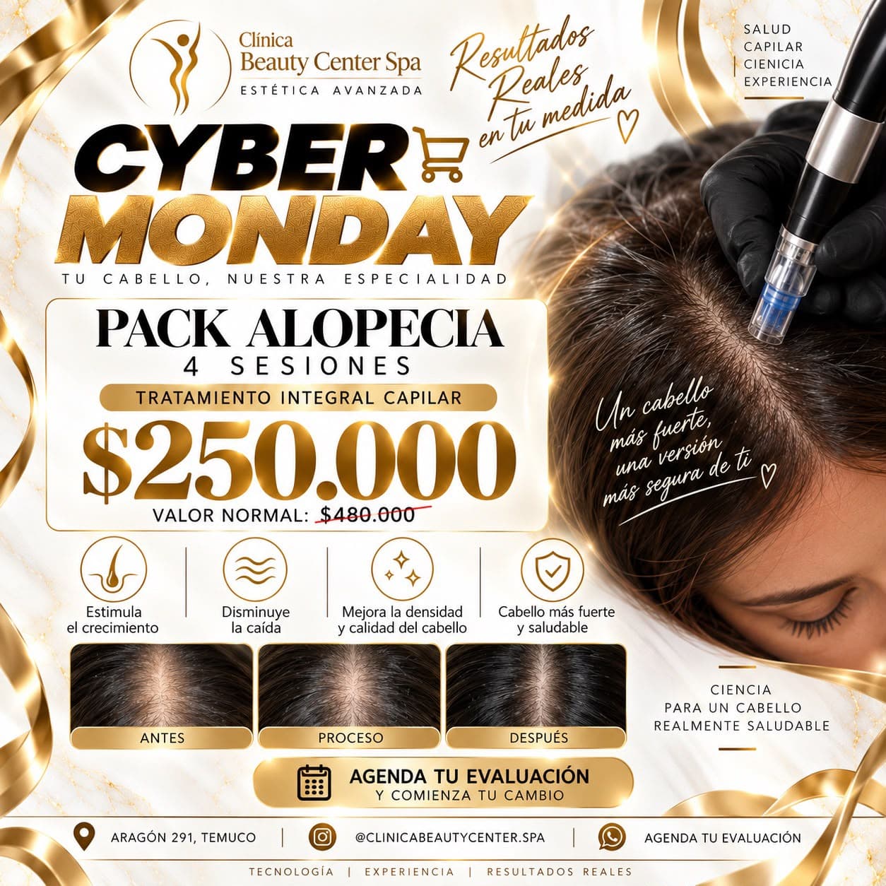 Promoción Cyber pack alopecia 4 sesiones a $250.000