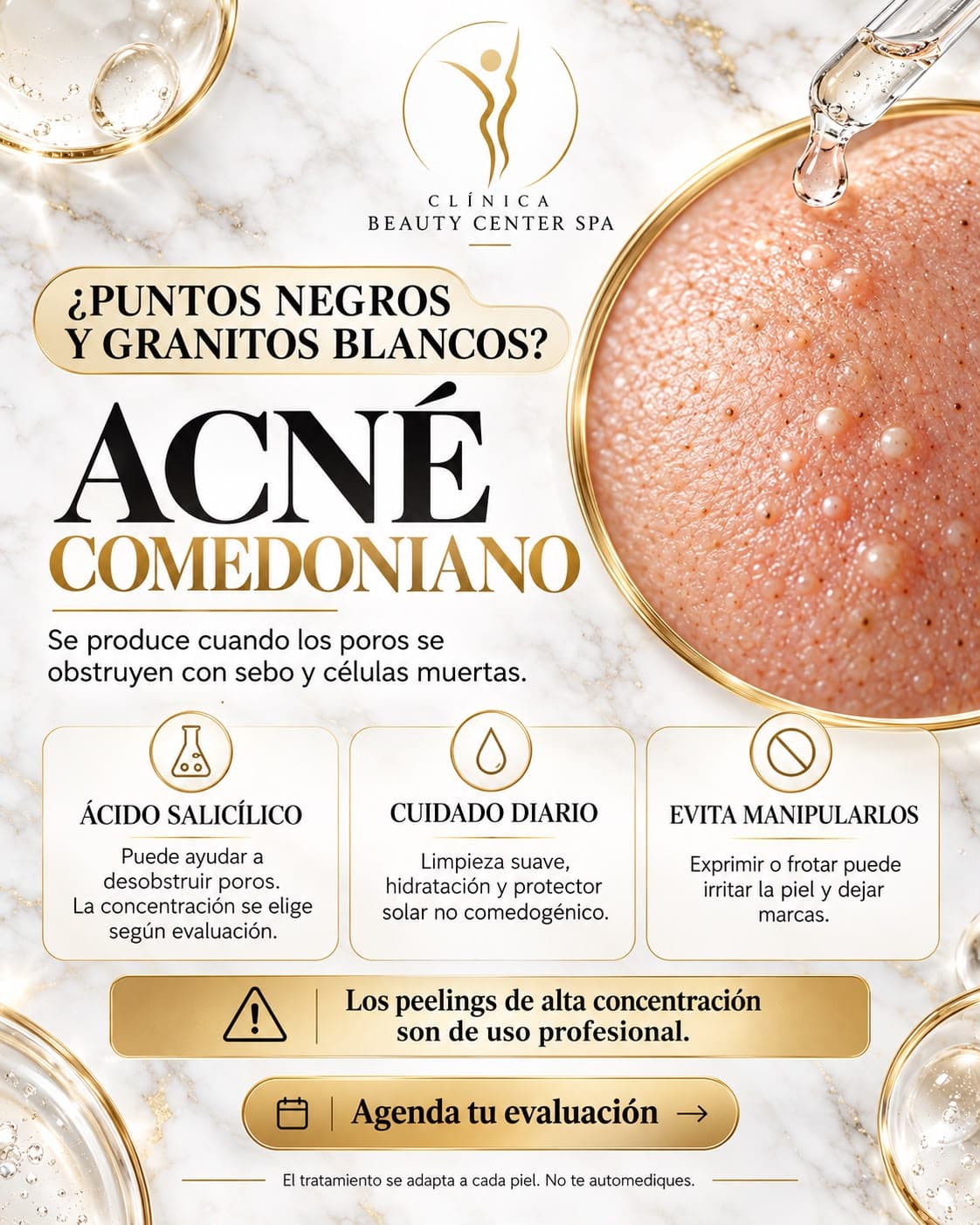 Infografía Acné comedoniano: puntos negros y granitos blancos