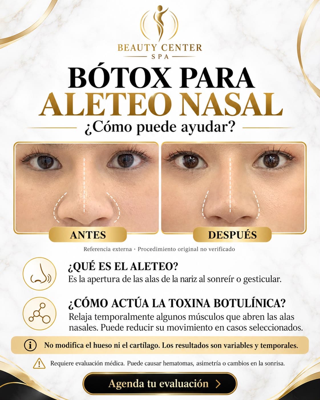 Bótox para aleteo nasal: cómo puede ayudar, antes y después (referencia externa, procedimiento no verificado)