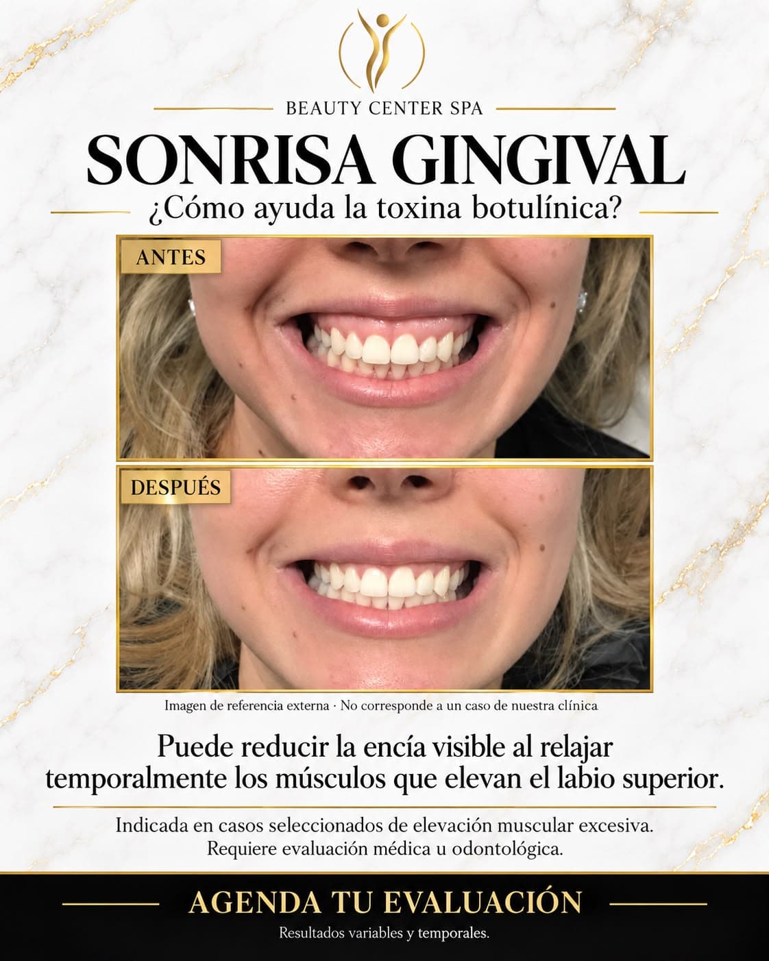 Sonrisa gingival antes y después con toxina botulínica (imagen de referencia externa, no corresponde a un caso de la clínica)
