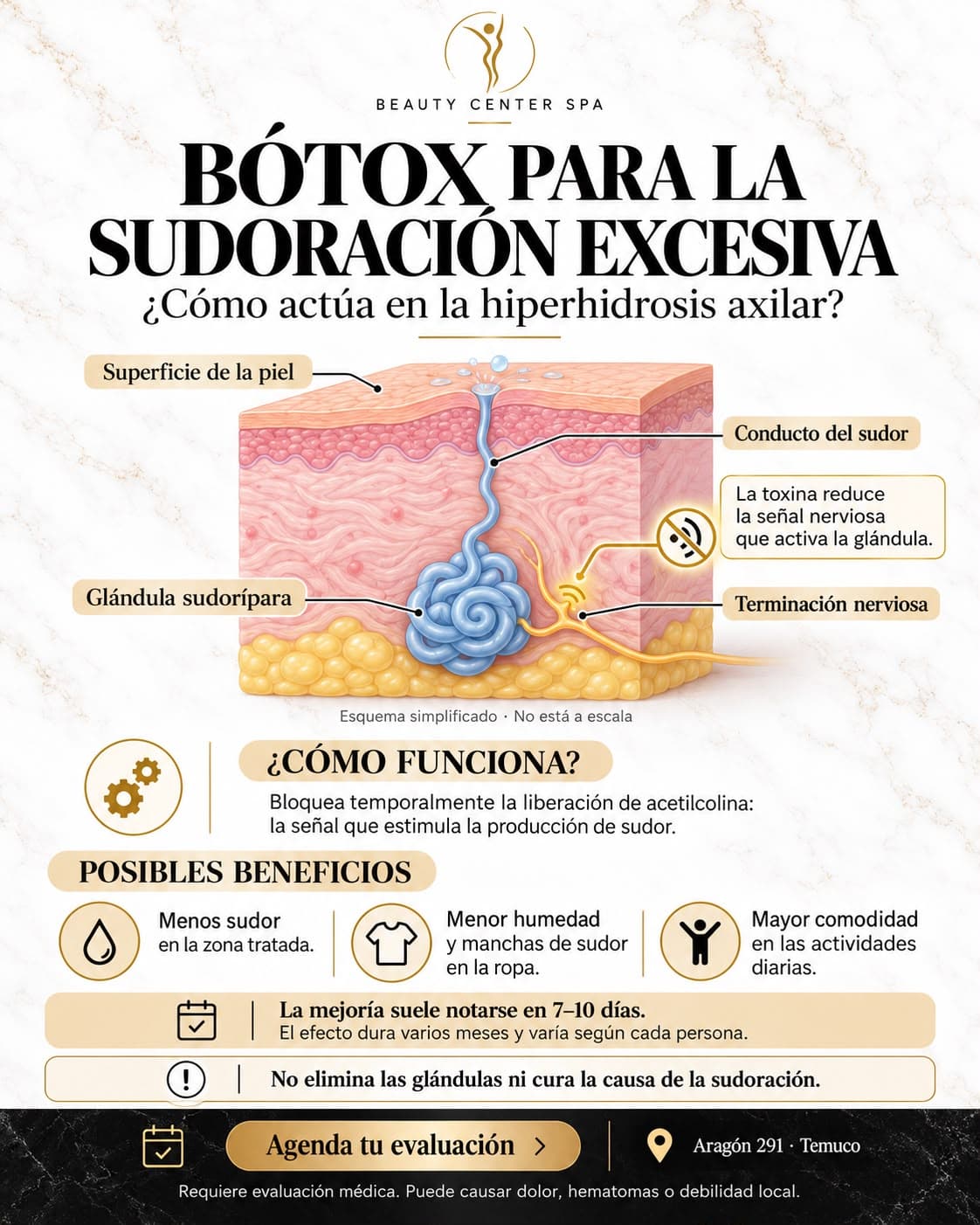 Infografía Bótox para la sudoración excesiva: cómo actúa en la hiperhidrosis axilar, esquema de la glándula sudorípara