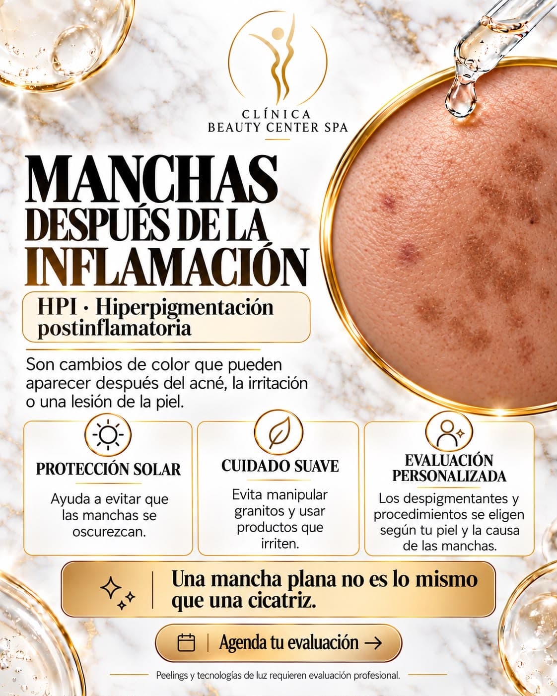 Infografía Manchas después de la inflamación: hiperpigmentación postinflamatoria (HPI)