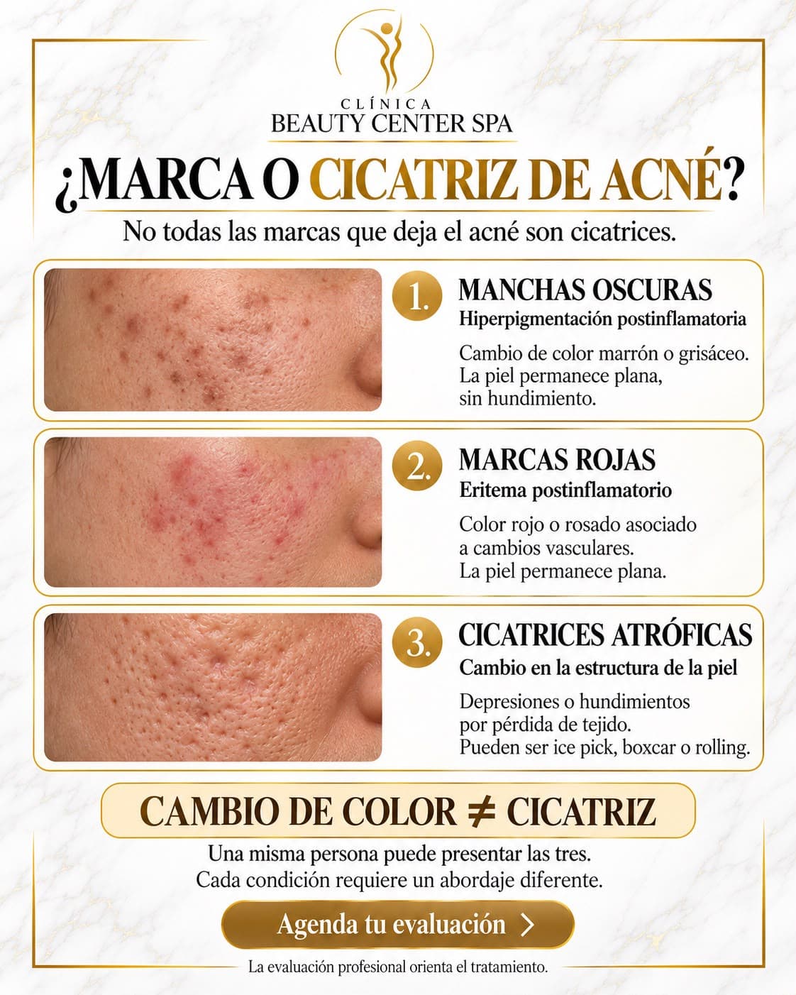 Infografía ¿Marca o cicatriz de acné? Manchas oscuras, marcas rojas y cicatrices atróficas