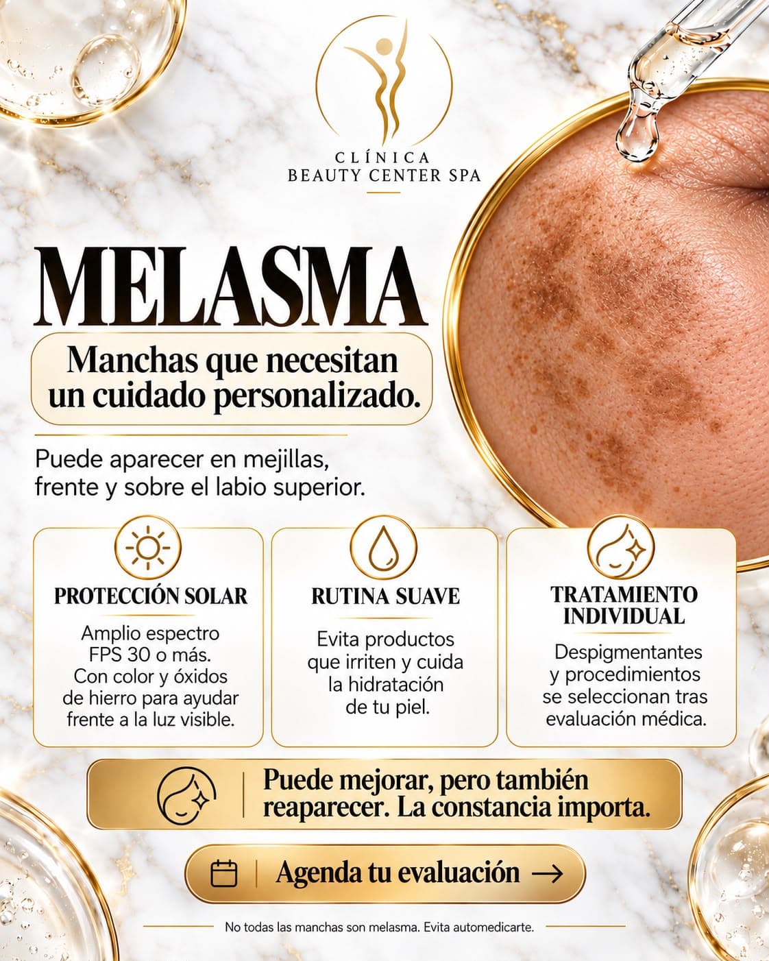 Infografía Melasma: manchas que necesitan un cuidado personalizado