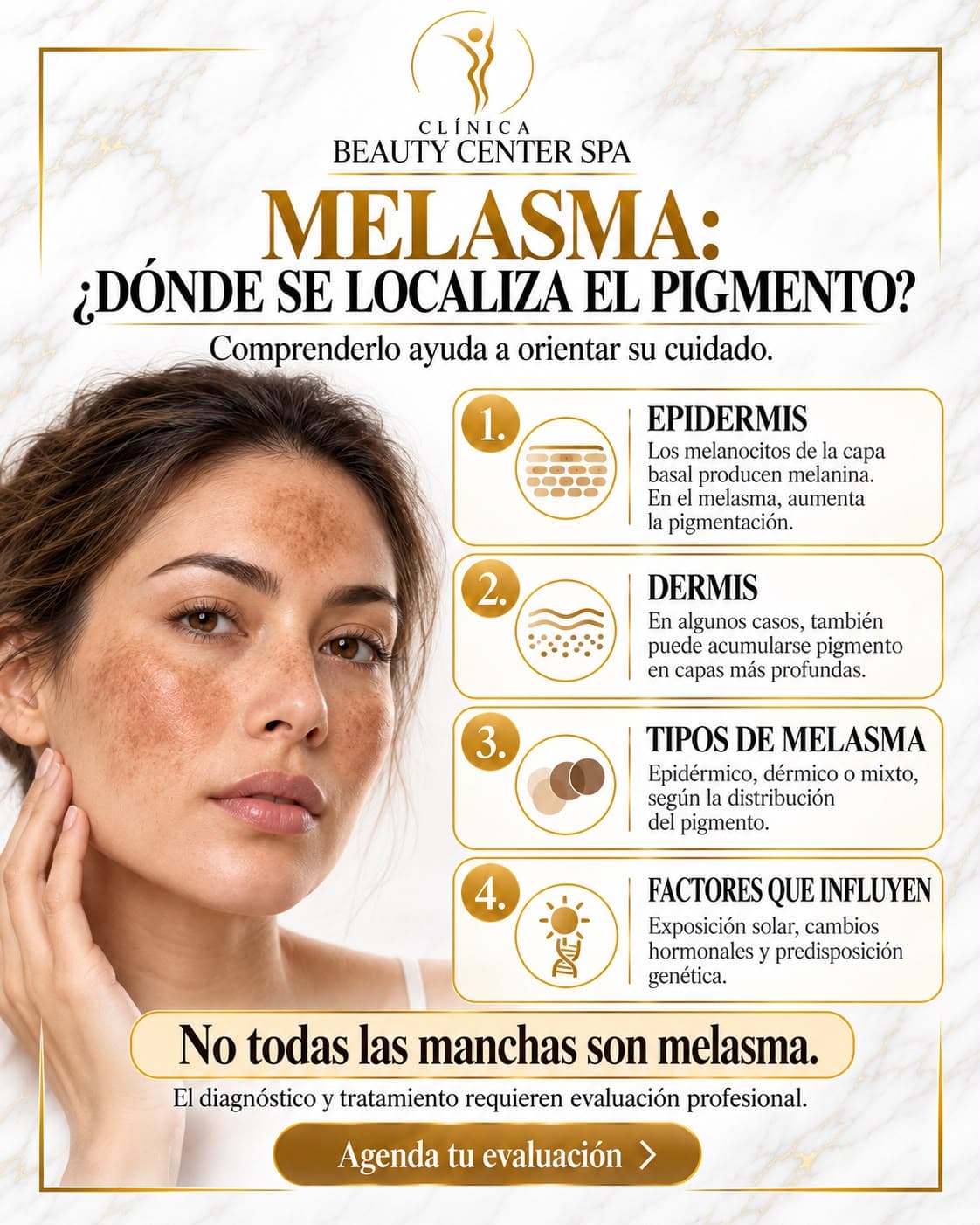 Infografía Melasma: dónde se localiza el pigmento