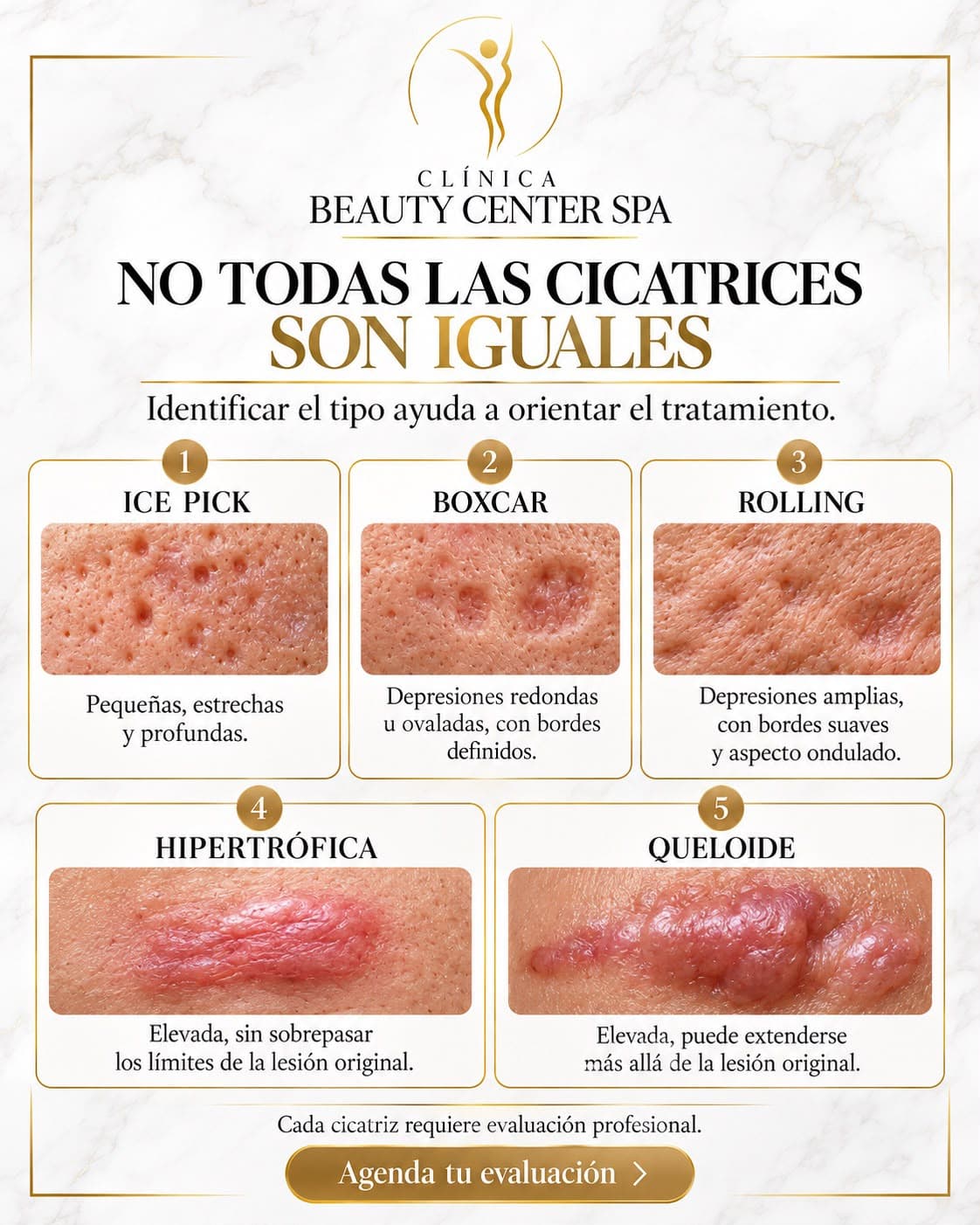 Infografía No todas las cicatrices son iguales: ice pick, boxcar, rolling, hipertrófica y queloide
